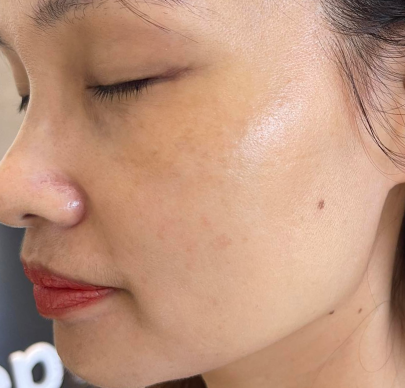 Dịch vụ trị nám