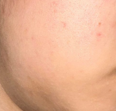 Dịch vụ trị mụn laser