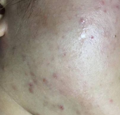 Dịch vụ trị mụn laser