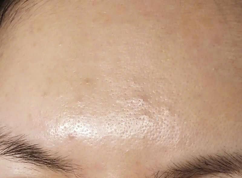 Trước và sau khi điều trị