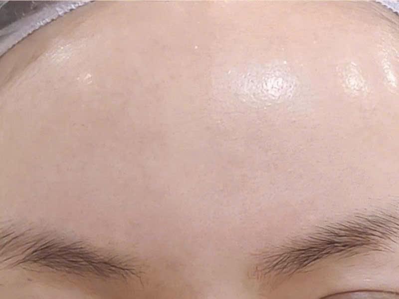 Trước và sau khi điều trị