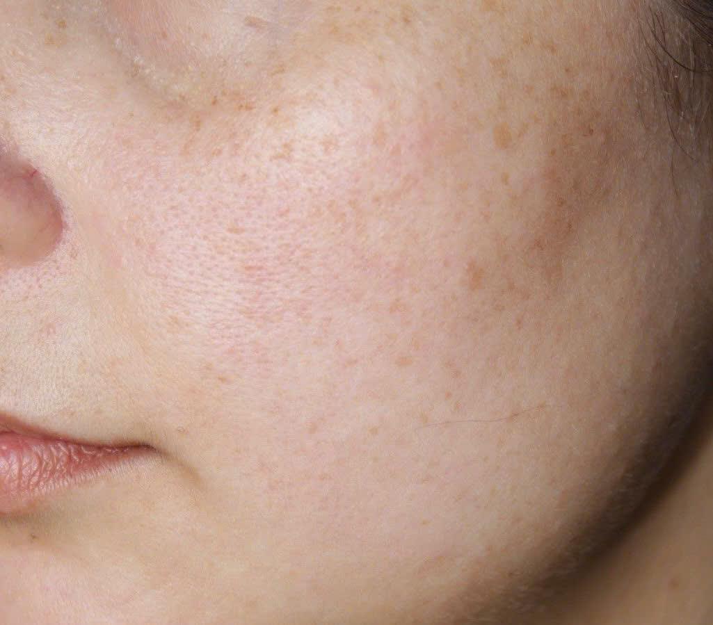 Trước và sau khi điều trị