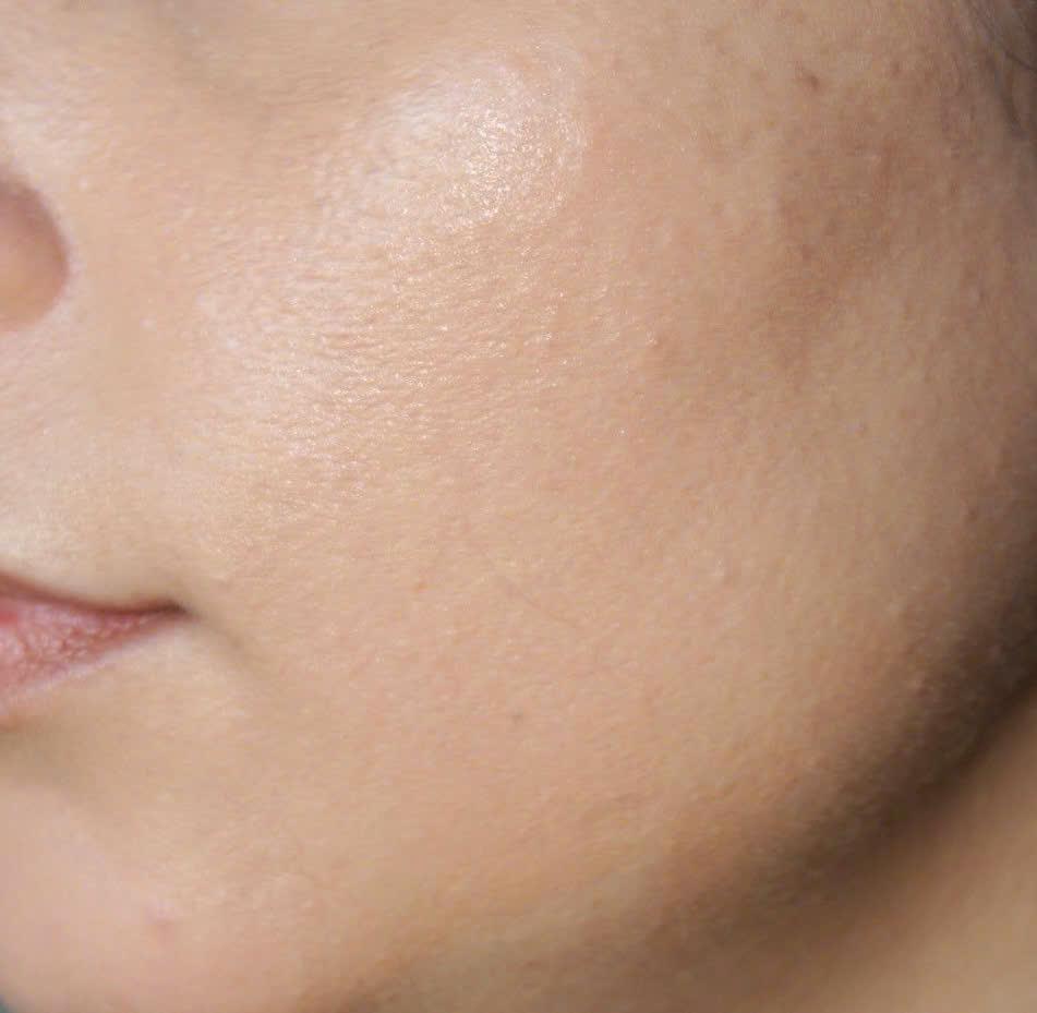 Trước và sau khi điều trị