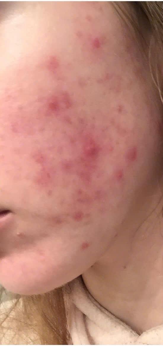 Trước và sau khi điều trị