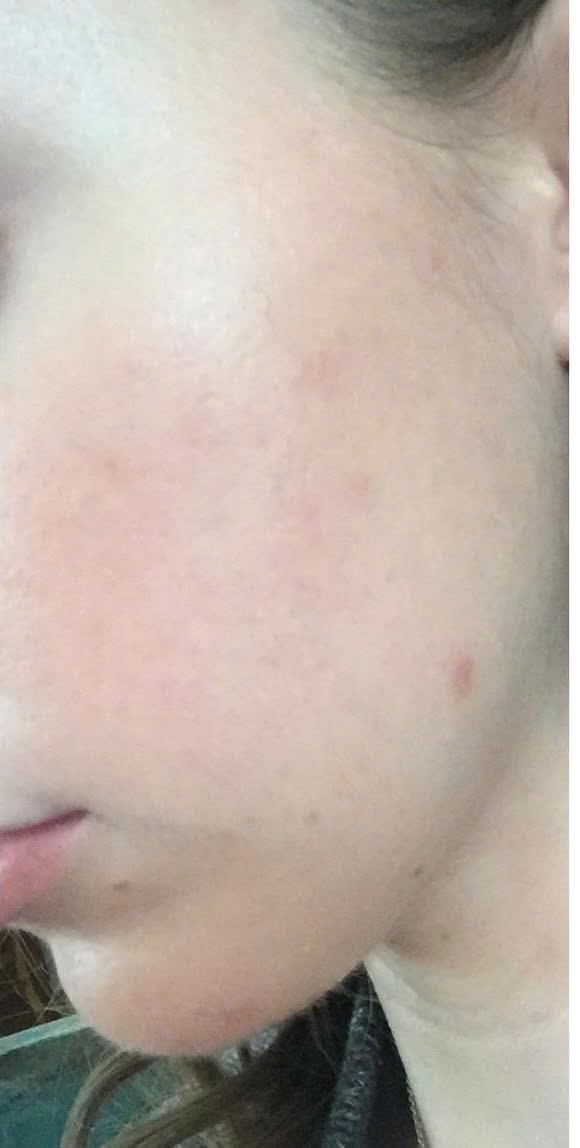 Trước và sau khi điều trị